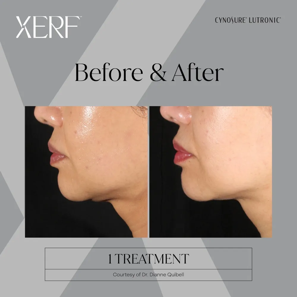 Before and after XERF treatment result showing improved lower-face firmness.