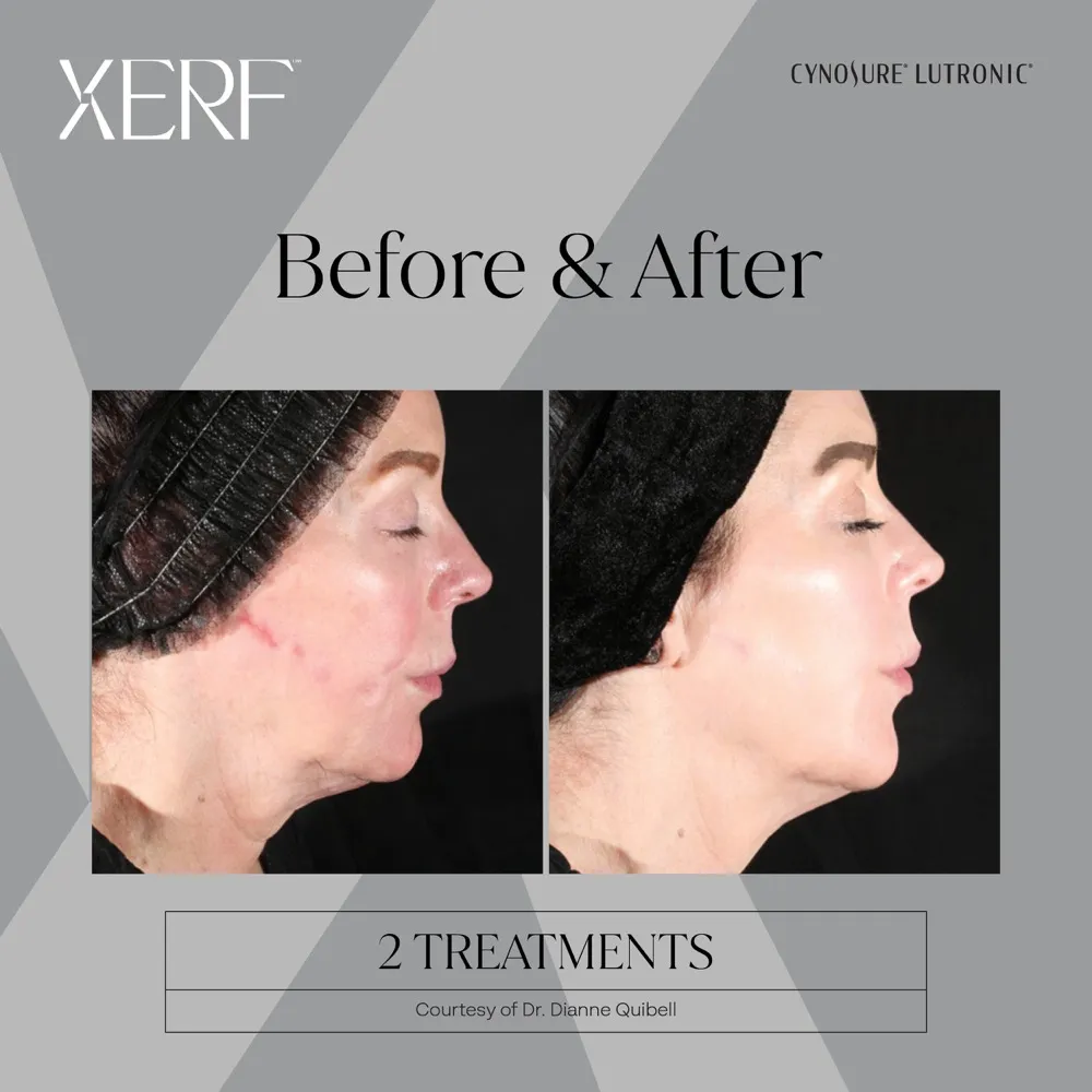 Before and after XERF treatment result showing improved skin texture and tightening.