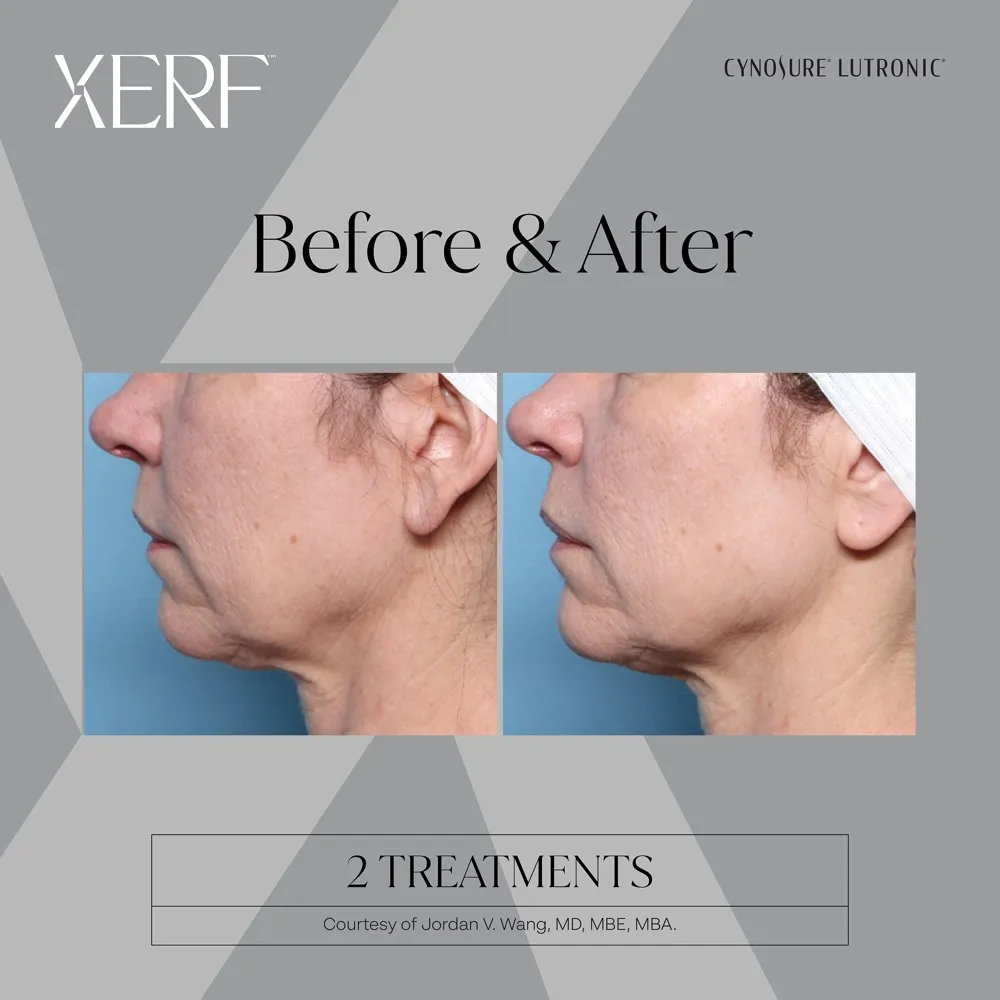 Before and after XERF treatment result showing jawline contour improvement.